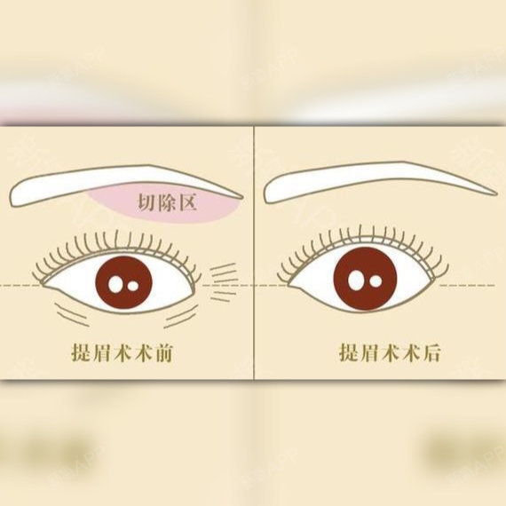 "眉蹙春山,眼颦秋水._圈子-新氧美容整形