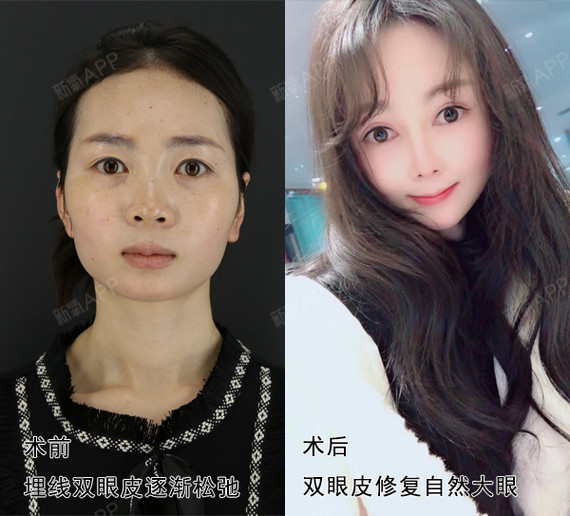 想拆掉回归到原来的单眼皮;有的人做完埋线双眼皮后,效果不理想,又不