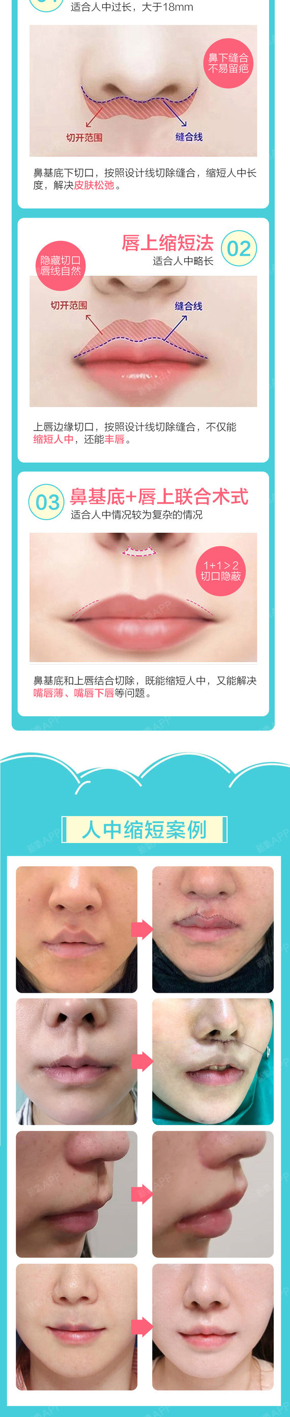 【人中缩短术】上唇过薄/人中过长/改善老态/人中加深