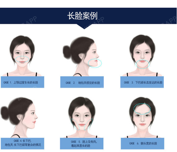 上颚过度生长的长脸 上颚(包括上牙在内的鄂骨在面部中属于鼻侧部分)