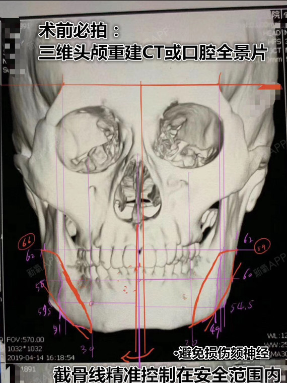 下颌角手术会不会嘴歪取决于这根线