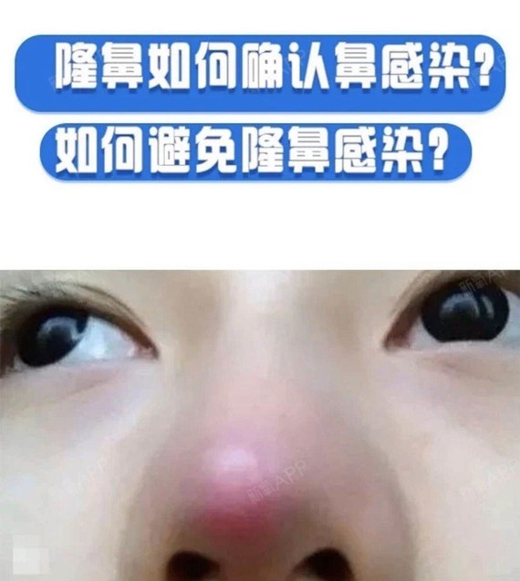 教你如何判断隆鼻后假体感染?