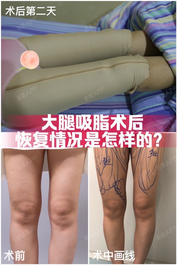 大腿吸脂术后恢复期是什么情况