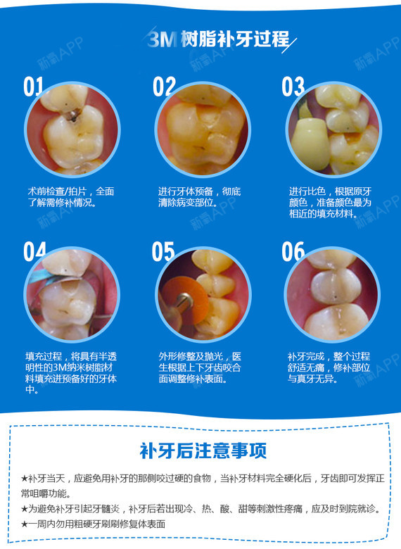 【补牙】两店通用进口3m树脂补牙 修复龋齿蛀牙 治疗牙痛 避免深度