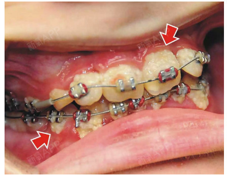 由于牙齿上的矫正装置会在牙面形成死角,若清洁不彻底容易造成脱矿