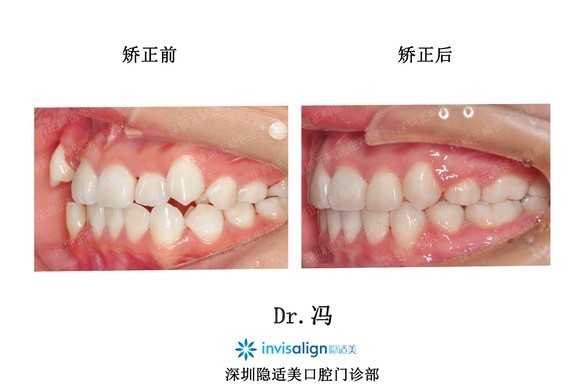 虎牙突出好看?要不要矫正?能不能拔掉