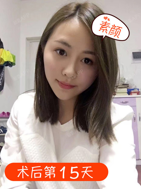 脂肪堆积的部位主要集中在颧区,面颊,下颌缘,有一定口角囊袋的问题
