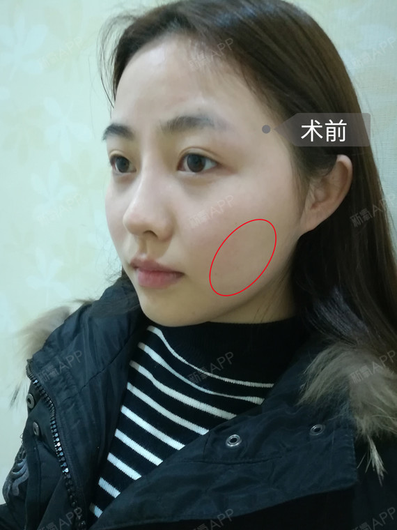 正面来看脂肪堆积的部位主要集中在颧区,面颊,下颌缘,有一定口角囊袋