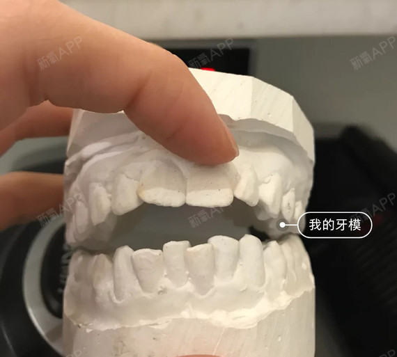 牙齿前突,如何辨别是牙性还是骨性?每天我们都会有很