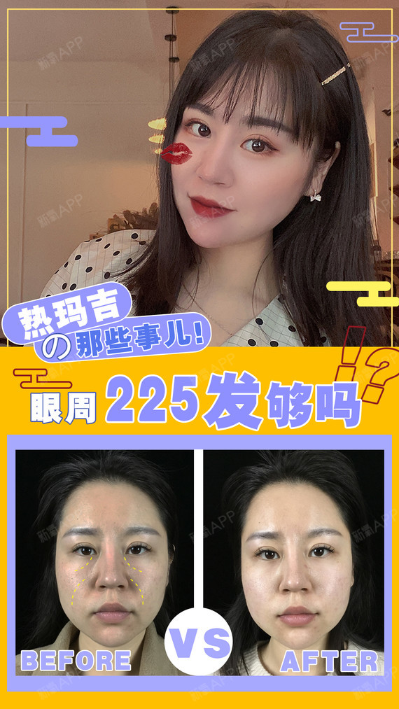 热玛吉眼周225发够吗?