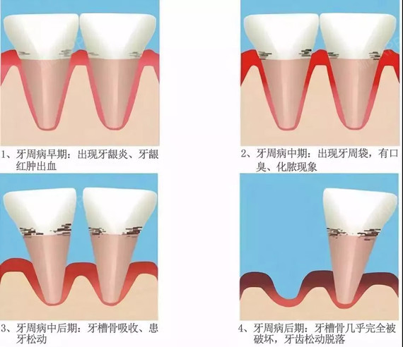 牙齿和牙槽骨之间有一个组织结构叫做牙周膜,也叫牙周韧带 牙齿就