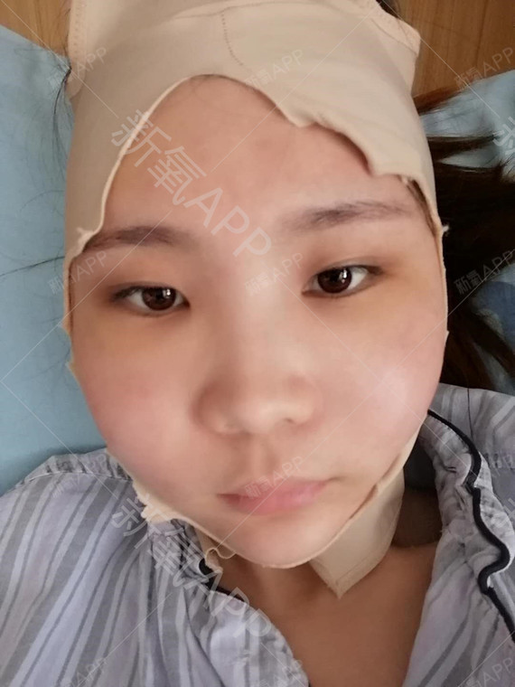颧骨内推 术后5天
