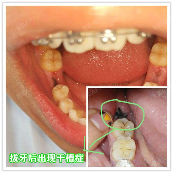 5,干槽症 主要症状:近来有拔牙的情况,通常在两到三天后拔牙窝内有