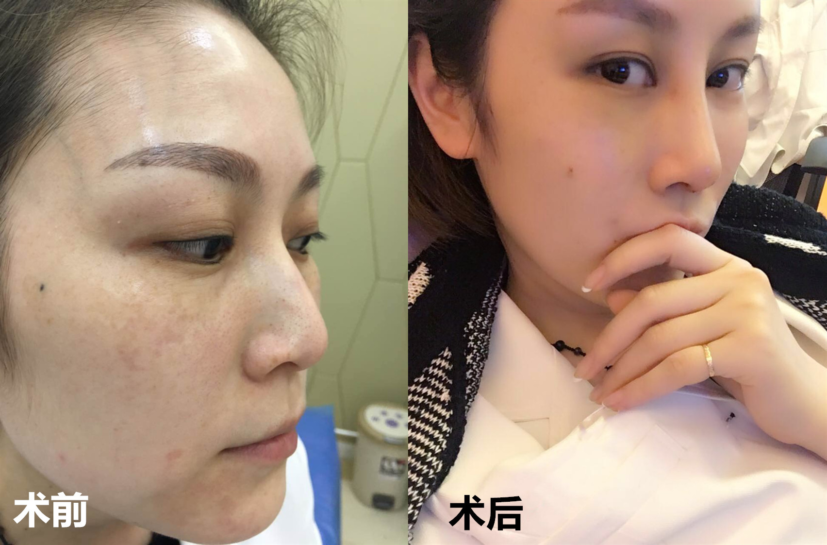 【做光子嫩肤后反黑?你一定踩了这些坑!】