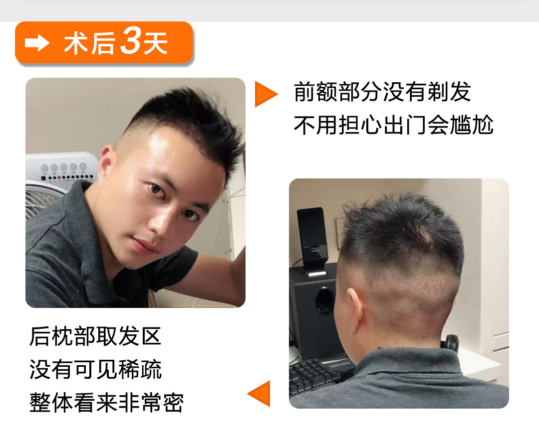 美人尖是指前额正中发际线向下凸一尖.