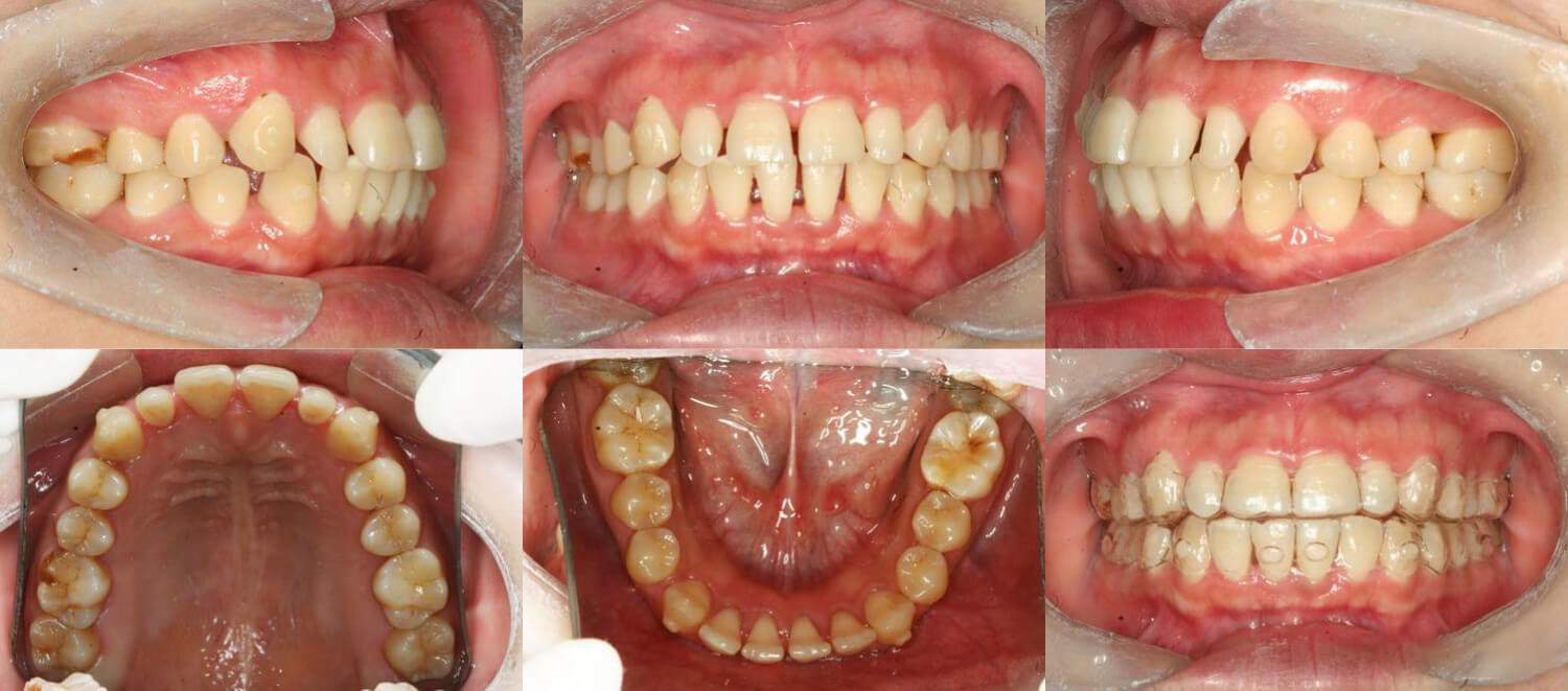 治疗前 这位女生才22岁,仅仅因为一口稀疏的牙齿,看上去就老了十岁不