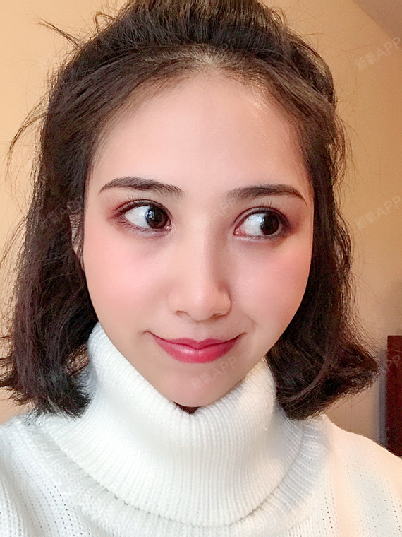 韩式三点or全切双眼皮 哪种更自然?