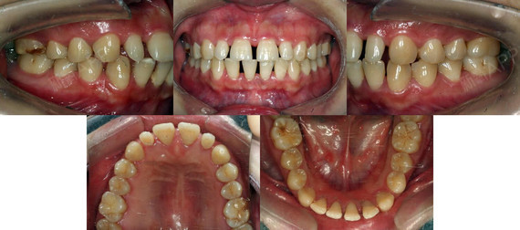 治疗前 这位女生才22岁,仅仅因为一口稀疏的牙齿,看上去就老了十岁不