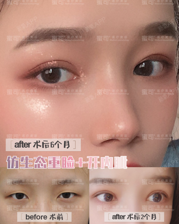 >> 1,外眦开大加内眦开大: 单纯的小眼症只需一起进行外
