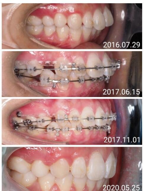 25 牙套类型:陶瓷自锁托槽 拔牙:4颗智齿 4颗正畸牙(上4下5 骨钉:3颗