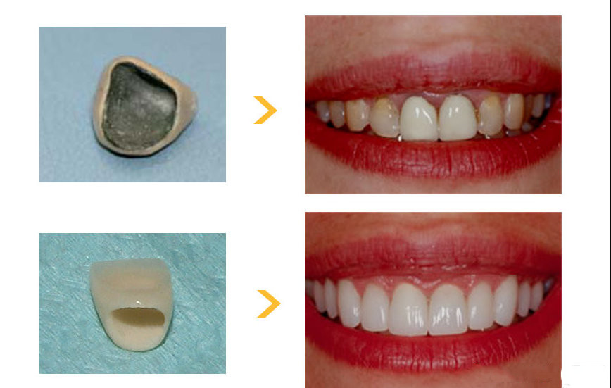 烤瓷牙与全瓷牙有什么区别?看完所有问题都会迎刃而解!
