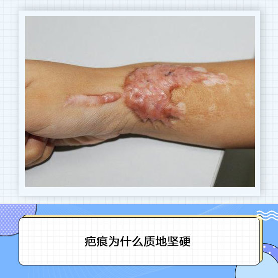疤痕增生是由纤维结缔组织过度增生引起的.增生疤痕形