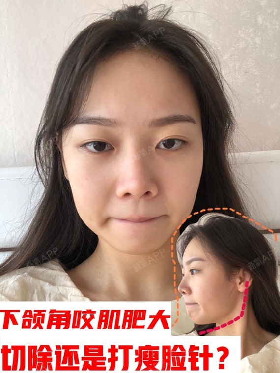 下颌角整形咬肌肥大,咬肌切除还是打瘦脸针好