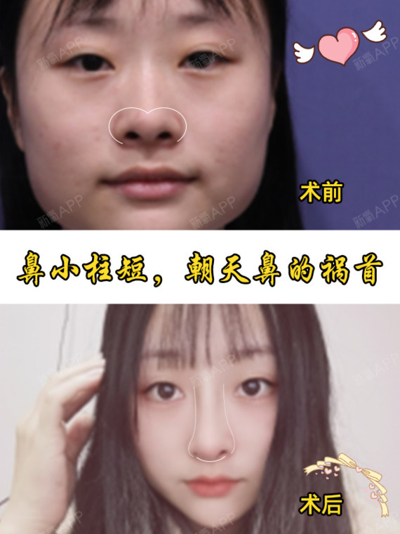 科普一下什么是鼻小柱,它有什么作用呢?