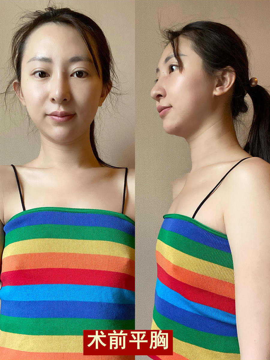 假体隆胸真人案例:假体隆胸毫无痕迹,简直太自然了!