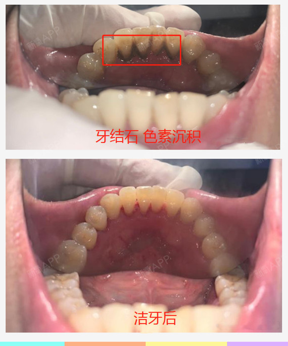 洗牙和龈下刮治,有什么区别?1,什么是口腔洁治(也_圈子-新氧美容整形