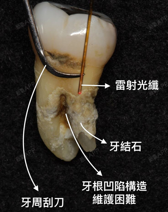 洗牙和龈下刮治,有什么区别?1,什么是口腔洁治(也_圈子-新氧美容整形