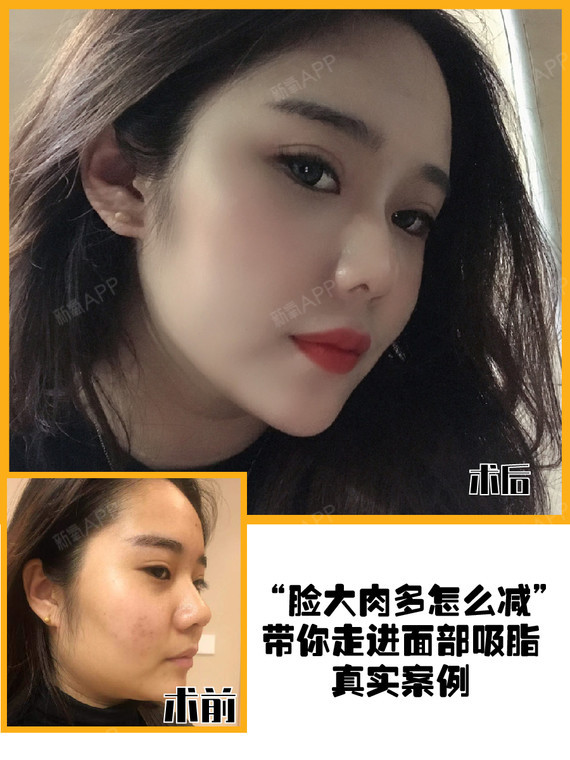 "脸大肉多怎么减"带你走进面部吸脂真实案例