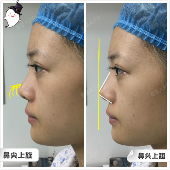 假体右滑↘,鼻头挛缩,这样的歪鼻,该如何修复?
