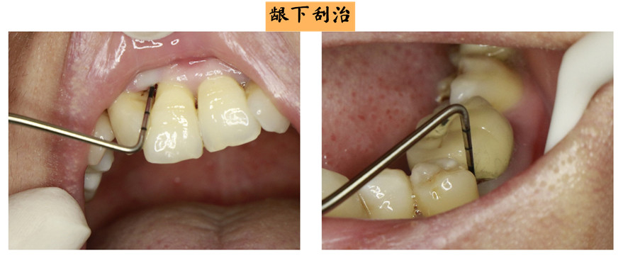 洗牙和龈下刮治有什么区别