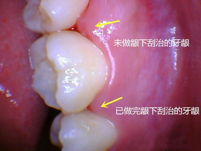 洗牙和龈下刮治有什么区别