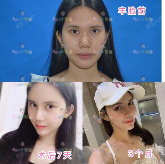 两腮鼓鼓的,取颊脂垫瘦脸怎么样?