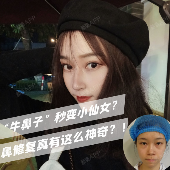 中庭低平,鼻基底凹陷,自称"牛鼻子"的小仙女,其实可以变身美