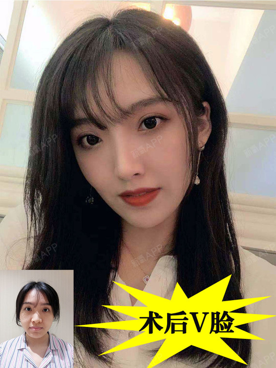 咬肌太发达,显脸大怎么办?用瘦脸针解决!