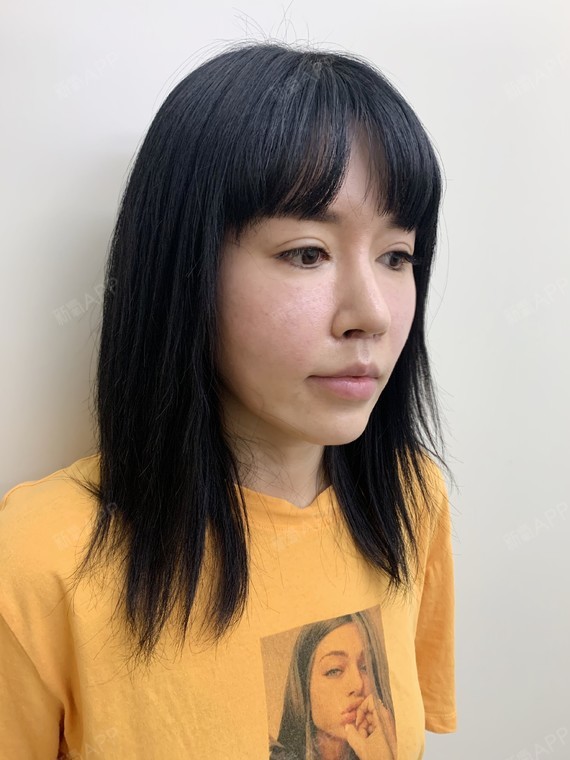 减龄小妙招:人中缩短术