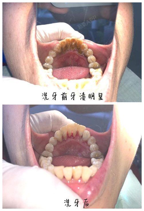 以及由于喝茶,喝咖啡,抽烟等在牙齿表面产生的色渍或是烟斑