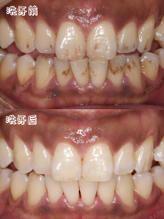 洗牙可以让牙齿变白吗?