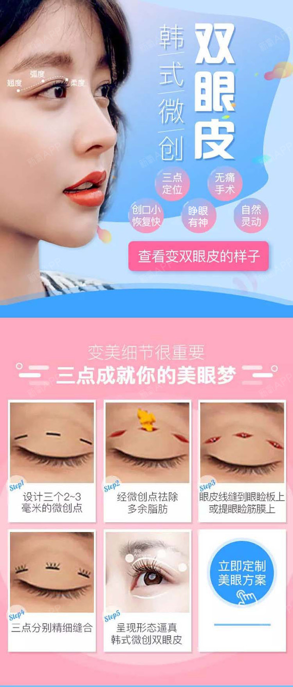 【定点双眼皮】【定点双眼皮】韩式三点切开双眼皮 精细微创仿生双