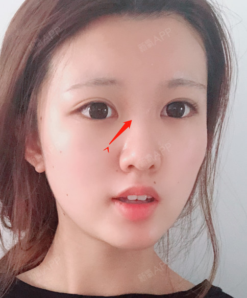 鼻梁假体的放置也不会使鼻子周围的皮肤拉紧,因为鼻部的皮肤本身就是