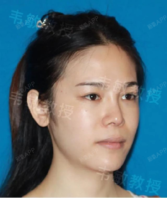 非常女性化了,优美的鹅蛋脸与她之前棱角鲜明的男性脸已是天差地别
