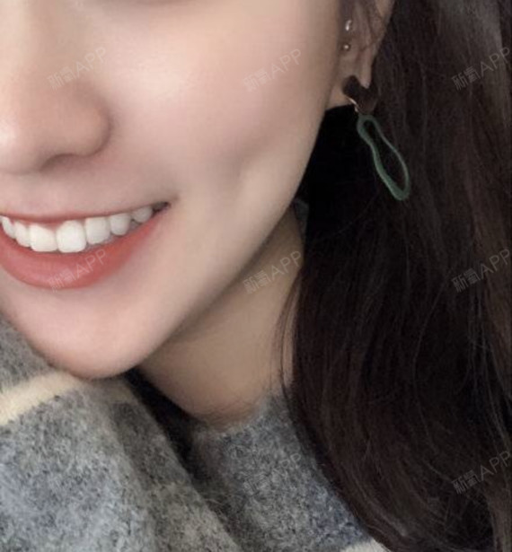 牙变白了,心情也变好了,又可以肆无忌惮的笑了