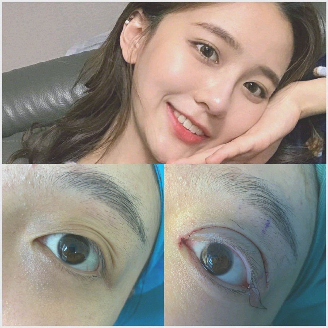 双眼皮变成三眼皮,多眼皮还有救吗?