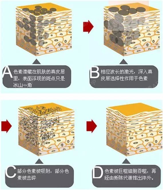 色斑的形成_圈子-新氧美容整形