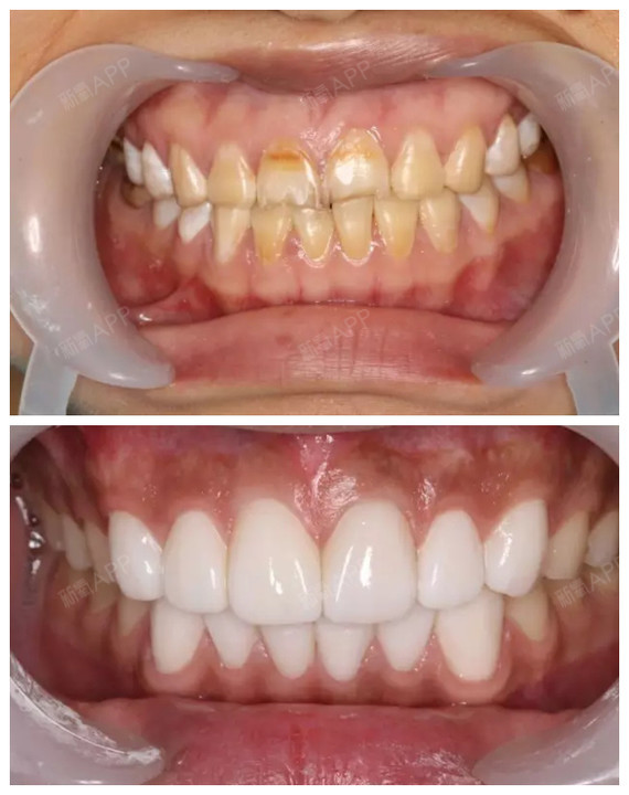美牙避坑指南【案例解说】牙齿贴面可以解决哪些牙齿_圈子-新氧美容
