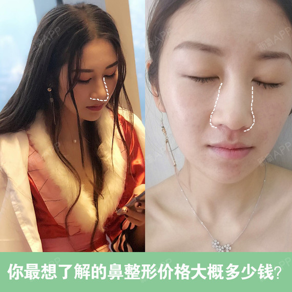 同的方法来解决,鼻部整形有很多项目,一般包括隆鼻术,鼻头鼻翼缩小术