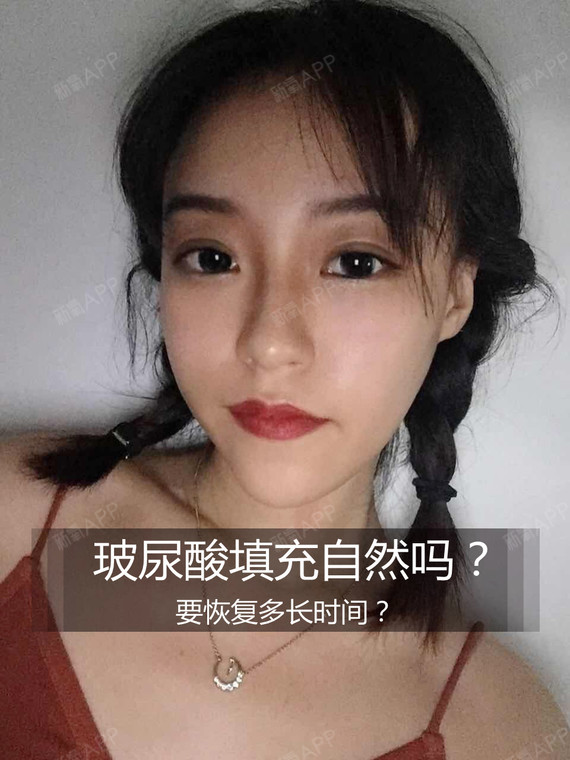 玻尿酸填充自然吗?要恢复多长时间?